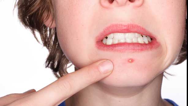 brufoli rimedi naturali