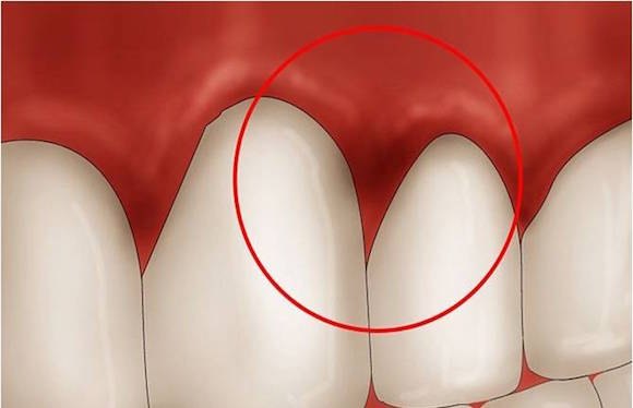 gengive che sanguinano