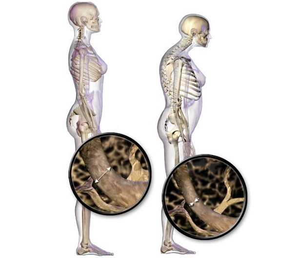 Osteoporosi