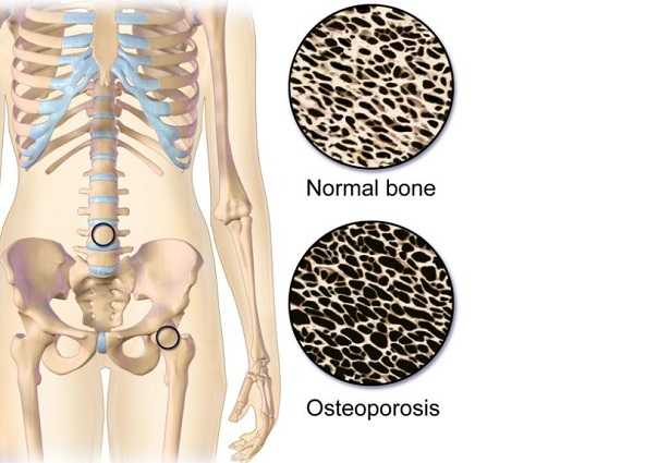 Osteoporosi