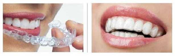 Apparecchio invisibile