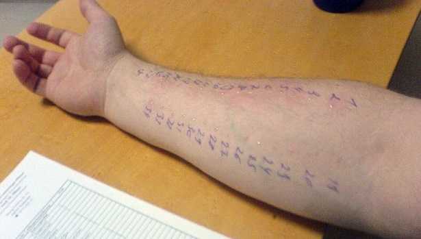Prick test