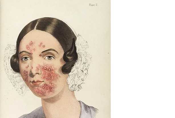 Acido azelaico Acido azelaico