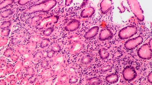 Helicobacter pylori Helicobacter pylori