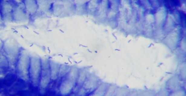 Helicobacter pylori Helicobacter pylori