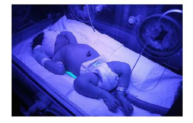 Fototerapia Fototerapia