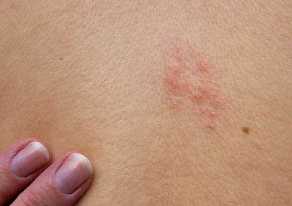 fuoco di sant antonio rimedi