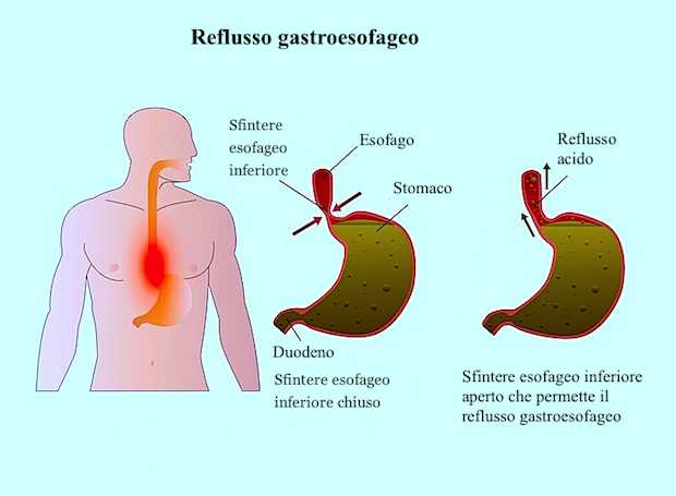 Reflusso gastrico alimentazione