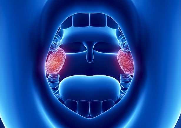 Tonsille gonfie, rimedi