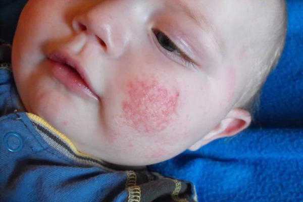 quinta malattia adulti bambini contagio sintomi cure