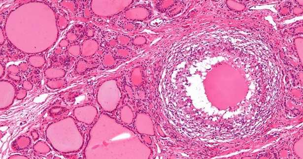 Tiroidite di Hashimoto