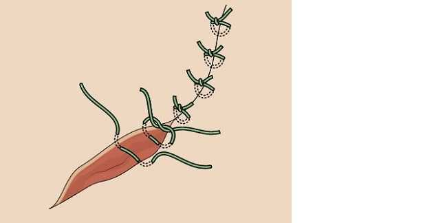 Colla di fibrina autologa Colla di fibrina autologa