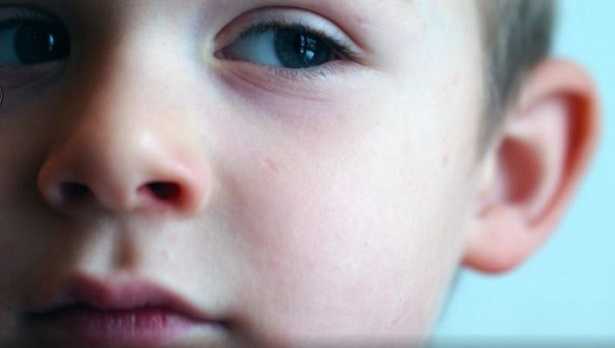 Dislalia: significato