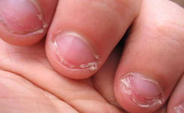 Come smettere di mangiarsi le unghie: liquido  