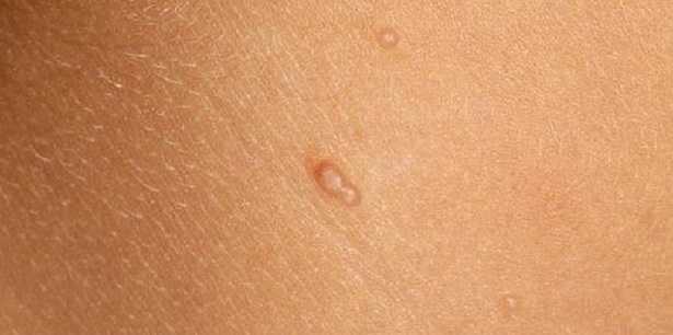 mollusco contagioso come si cura