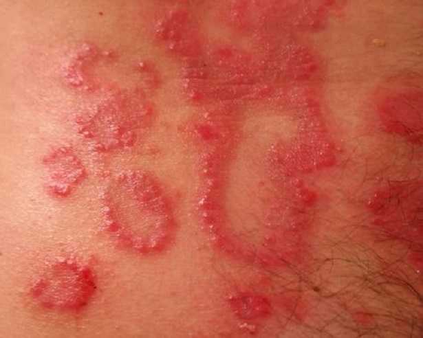 Psoriasi: cause Psoriasi: cause