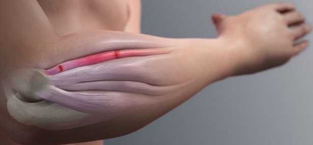 Proloterapia Proloterapia