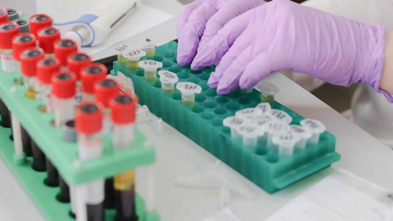 Bilirubina Diretta Alta Quando Preoccuparsi Idee Green Bilirubina Diretta Alta Quando Preoccuparsi Idee Green