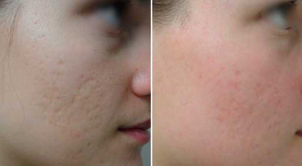 curare le cicatrici da acne