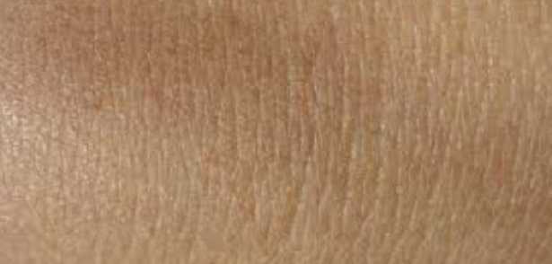 Come si trasmette la scabbia