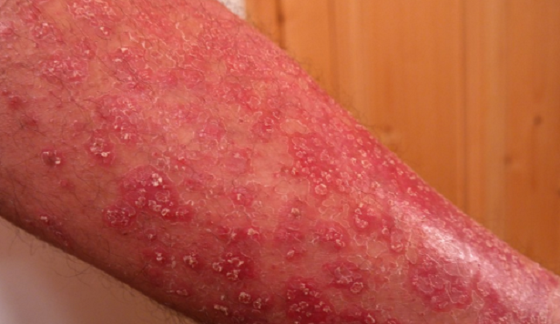 Malattie psicosomatiche della pelle