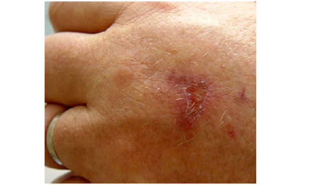 Piante che provocano ustioni