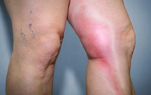 Linfangite arti inferiori