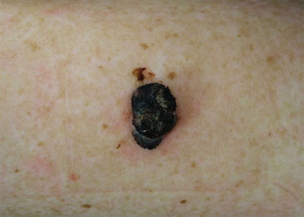 melanoma